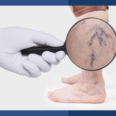 magnified view of varicose veins
