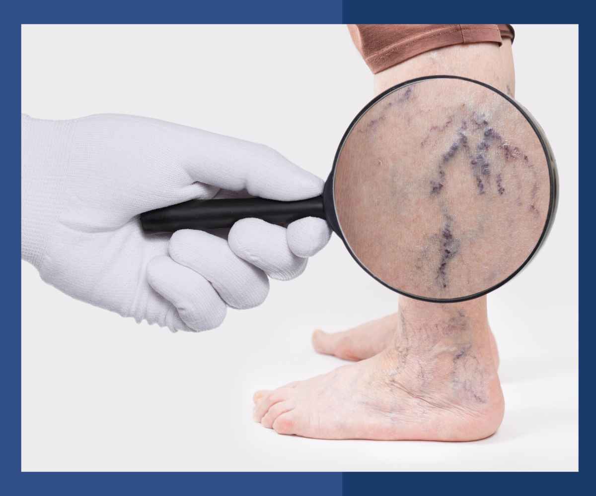 magnified view of varicose veins