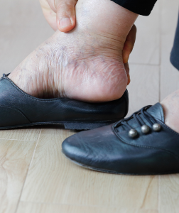 woman with swollen feet putting on shoes