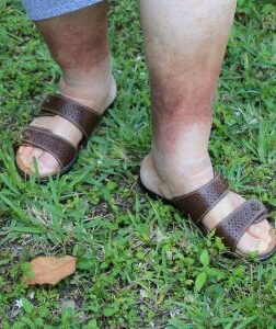 woman walking in grass with skin discoloration on legs
