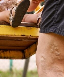 person with varicose vein legs pushing swing