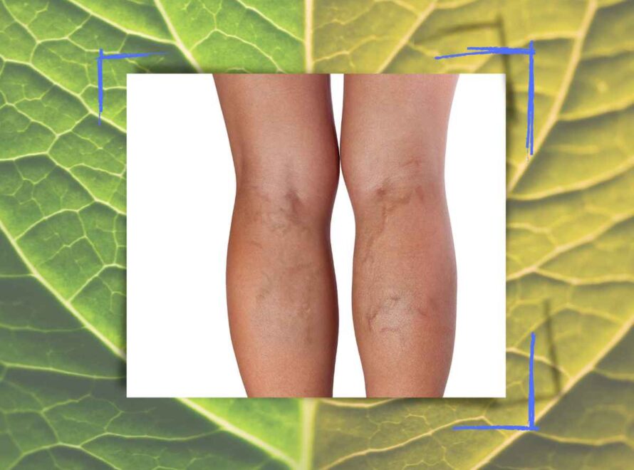 legs with spider veins
