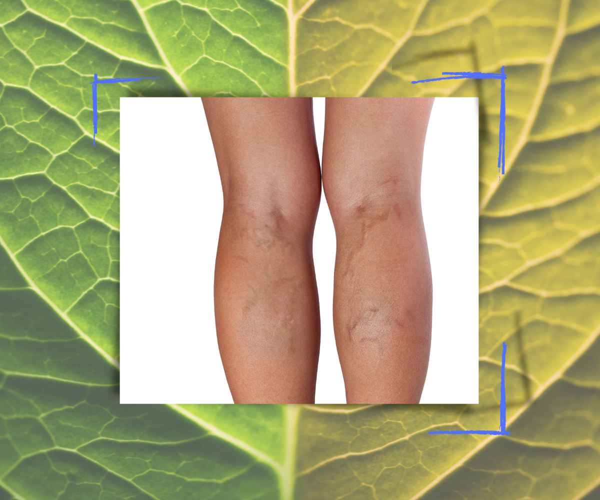 legs with spider veins