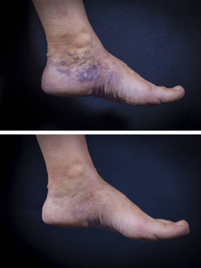 foot with varicose veins before and after