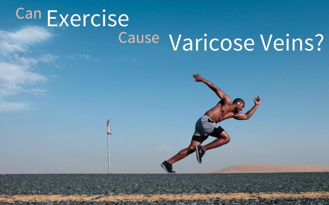 Can Exercise Cause Varicose Veins?