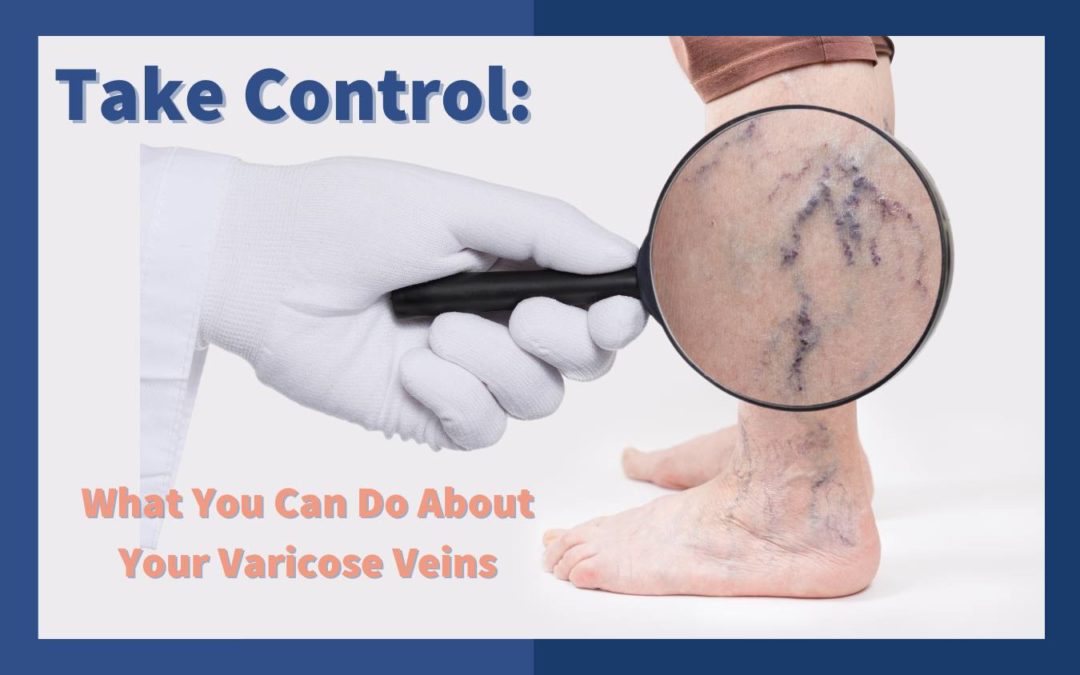 magnifying glass over leg with varicose veins