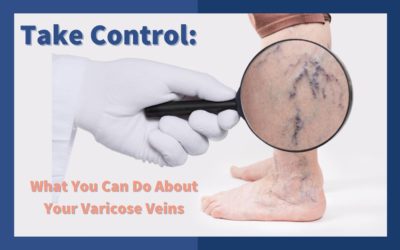 Taking Control: What You Can Do About Your Varicose Veins